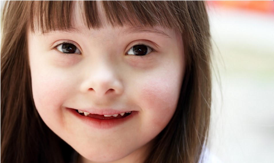 Downs Syndrome (1)