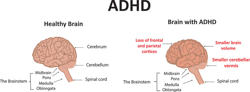 ADHD - Sound Therapy International
