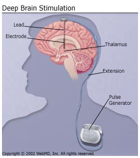 Parkinsons_Disease_Deep_Brain_Stimulation_Deep_Brain_Stimulation - US ...